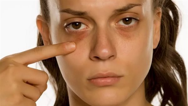 وداعًا للهالات السوداء 10 وصفات طبيعية لعلاجها