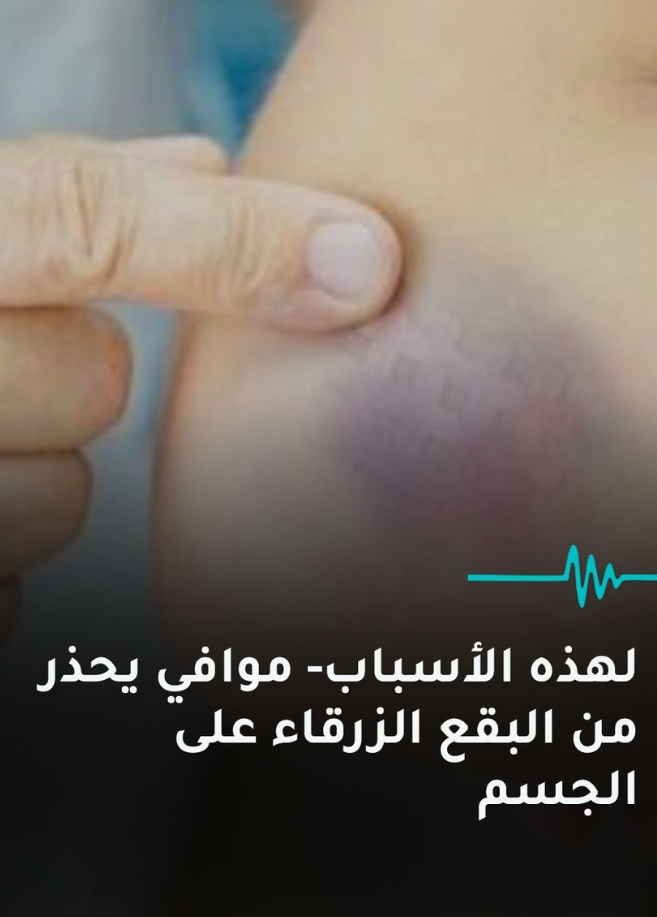 لهذه الأسباب موافي يحذر من البقع الزرقاء على الجسم