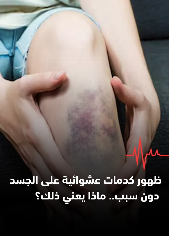 ظهور كدمات عشوائية على الجسد دون سبب.. ماذا يعني ذلك؟