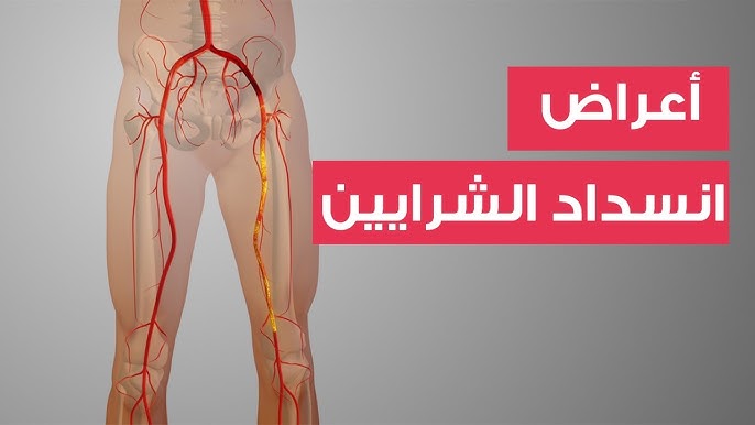 انتبه لساقيك- 6 أعراض لانسداد الشرايين تظهر عليهما
